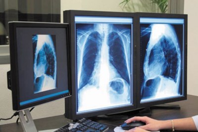 480.000 cas de tuberculose multirésistante recensés dans le monde en 2014