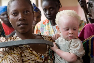 Une femme tient dans ses bras un enfant atteint d’albinisme