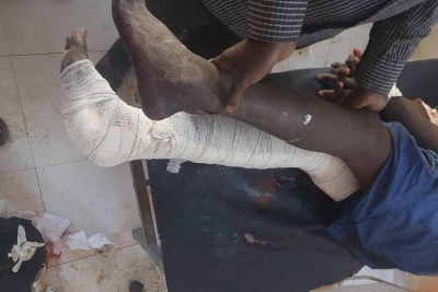 A patient in the MSF-supported Nyala Teaching Hospital in South Darfur received treatment for injuries caused by airstrikes on February 3, 2025. MSF has since been forced to withdraw from the North as violence escalates.